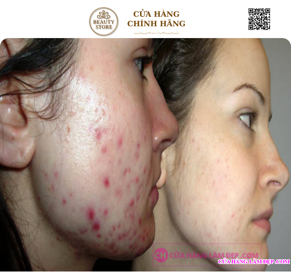 Kem Giảm Mụn, Lão Hoá Da Obagi T.R.E Cream USP 0,025%