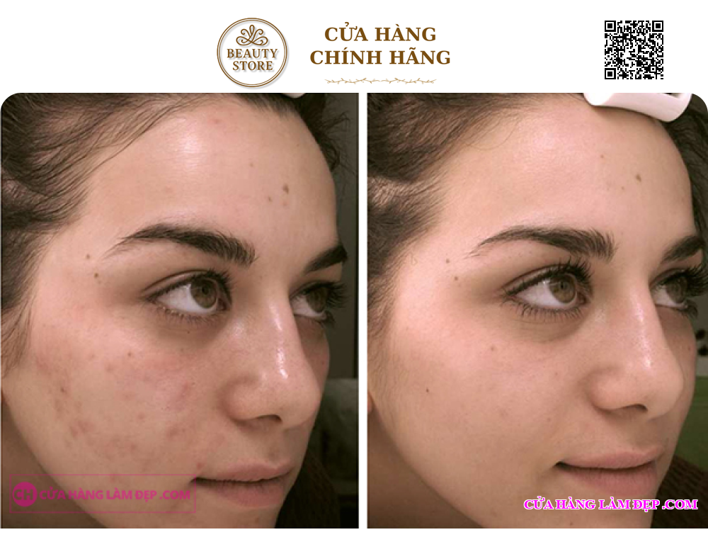 Kem Giảm Mụn Chuyên Biệt La Roche-Posay Effaclar Effaclar A.I.